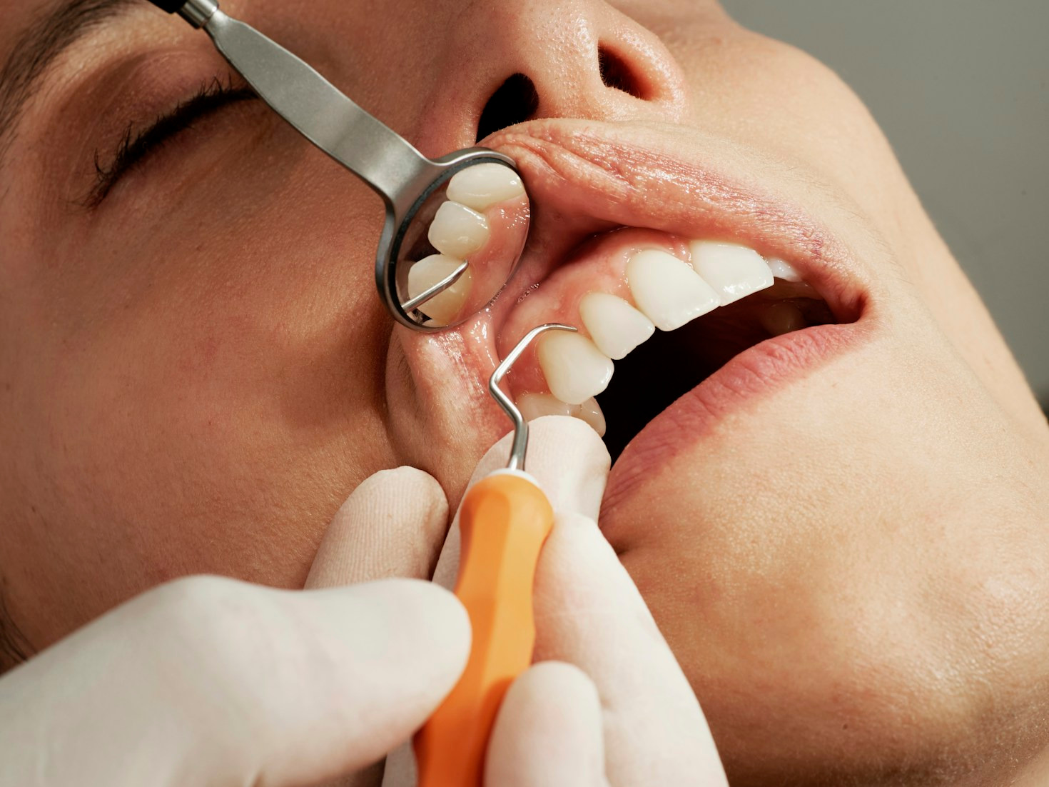 Comment bien préparer votre pose d&rsquo;implants